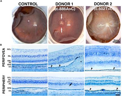 Cellular Changes in Retinas From Patients With BEST1 Mutations